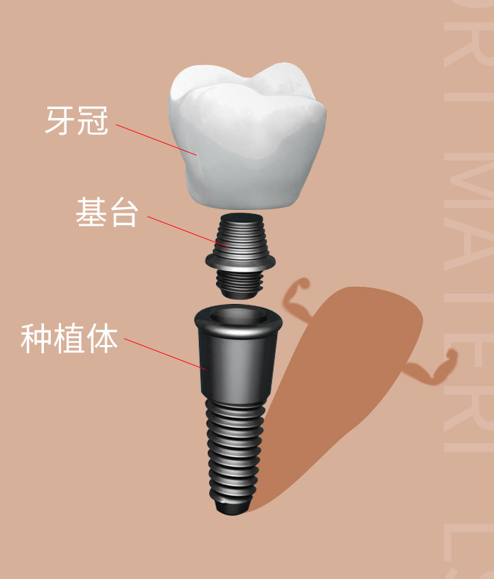 种植牙的构造图