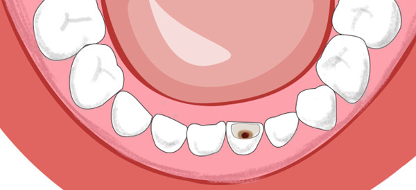 蛀牙牙洞