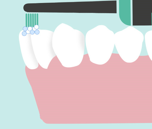 在做牙齿矫正期间怎么正确刷牙呢