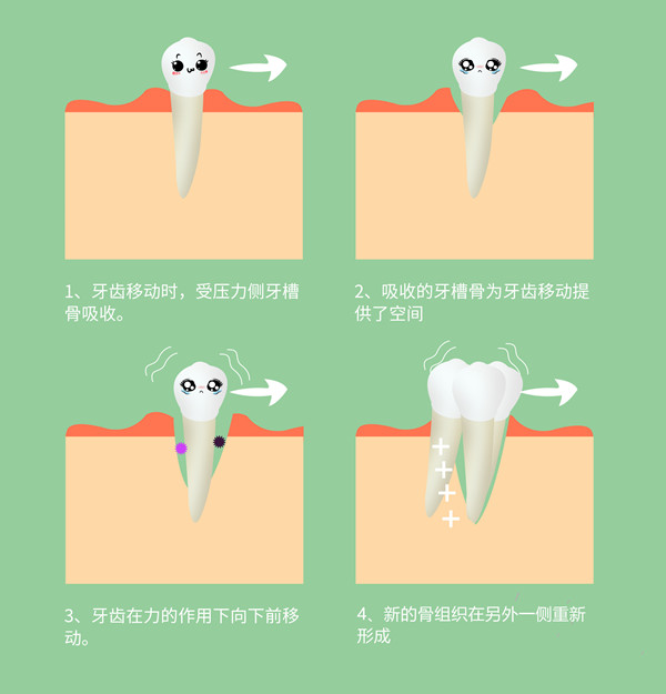 牙齿矫正过程